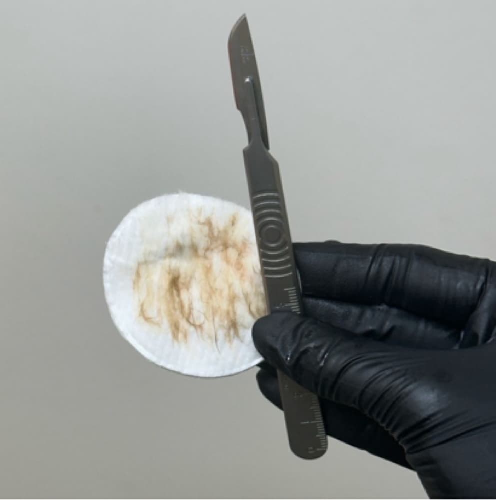 Dermaplaning